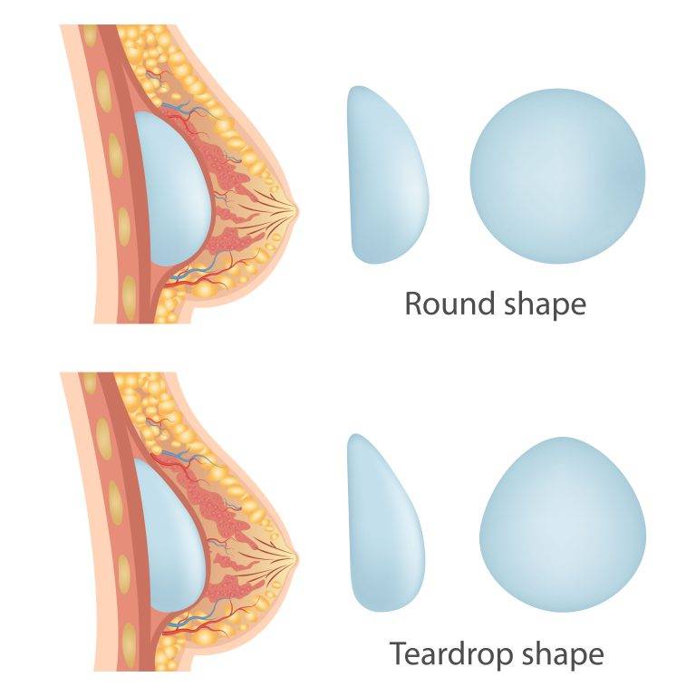 breast implant shapes